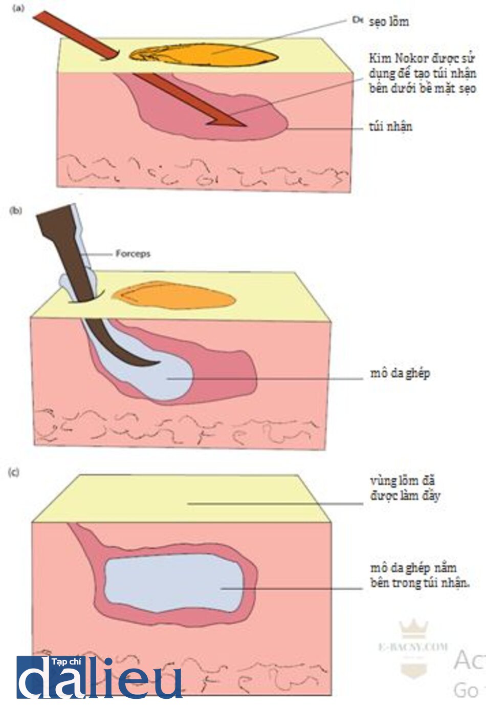 HÌNH 12.3 ghép da. (a) sẹo lõm đầu tiên được cắt đáy để tạo túi nhận mô ghép. (b) sử dụng forceps Jeweller để đưa mảnh da ghép vừa được thu hoạch vào túi nhận qua đường rạch da được tạo ra bởi kim cắt đáy sẹo. (c) Sau khi hoàn tất thủ thuật, vùng lõm đã được làm đầy đến ngang mức với mô xung quanh.