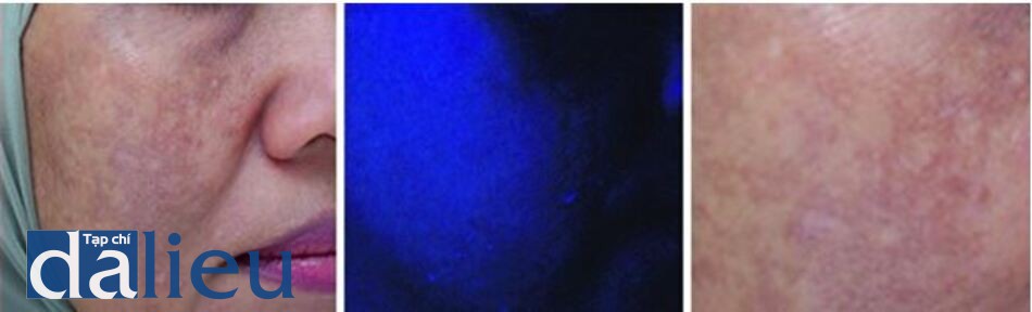  Hình 6.3 (a) Nám bì ở má phải. (b) Vùng nám không đậm màu hơn dưới ánh sáng đèn Wood. (c) Soi da bằng dermoscopy cho thấy hình ảnh tăng sắc tố giả lưới lan tỏa màu nâu đậm đến xanh.