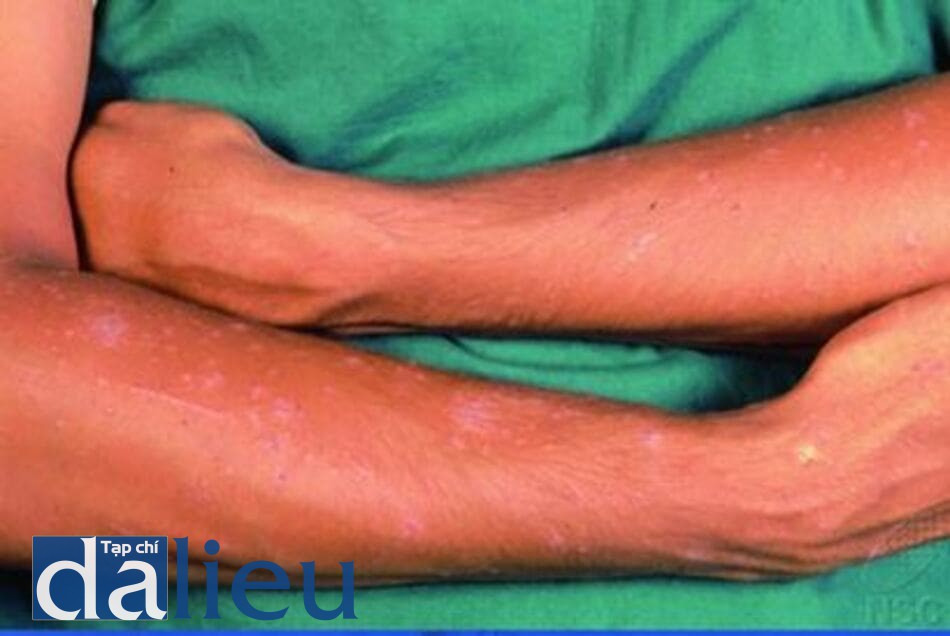 Hình 9.6 (a) Sẩn tróc vảy ở trên cánh tay của một người đàn ông Châu Á, kết quả mô bệnh học xác nhận là tổn thương của liken phẳng ánh sáng (Ảnh của Viện Da Liễu Quốc Gia, Singapore).