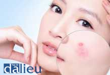 Công nghệ ly quang nhiệt vi điểm trong điều trị sẹo trứng cá