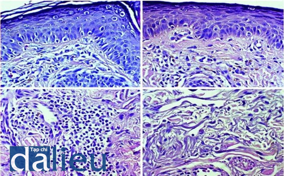Hình 7.2 Kết quả mô bệnh học của nám được đặc trưng bởi (a) melanocyte kích thước lớn ở thượng bì, (b) đại thực bào mang sắc tố ở lớp bì nhú, (c) xâm nhiễm bạch cầu lympho quanh mạch máu, và (d) thoái hóa mô đàn hồi (H&E x400)