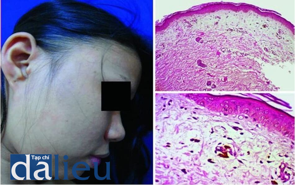 Hình 7.6 Ashy dermatosis ở một phụ nữ Philippin (a) và hình ảnh mô bệnh học (b, c) các không bào nhỏ ở lớp đáy và tích tụ sắc tố ở lớp bì (H&E x100 (b), x400 (c))