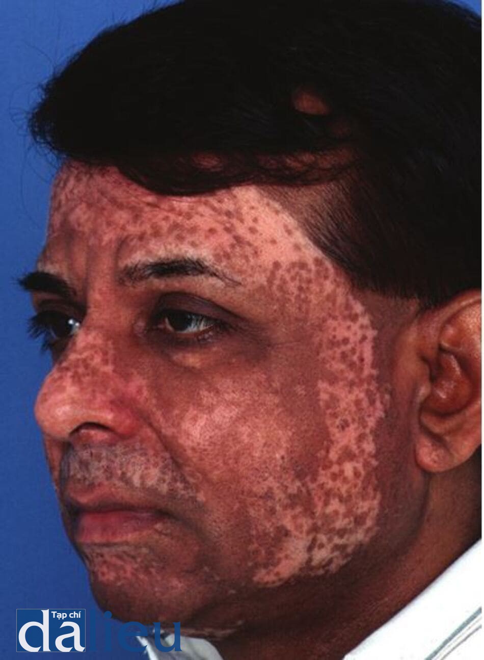 Hình 11.19 Một bệnh nhân có da phức tạp (của Ấn Độ) cho thấy sự mất sắc tố và tông màu không đông đều 1 năm sau tái tạo bề mặt bằng laser C02.