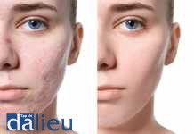 Sẹo trứng cá ở bệnh nhân châu Á