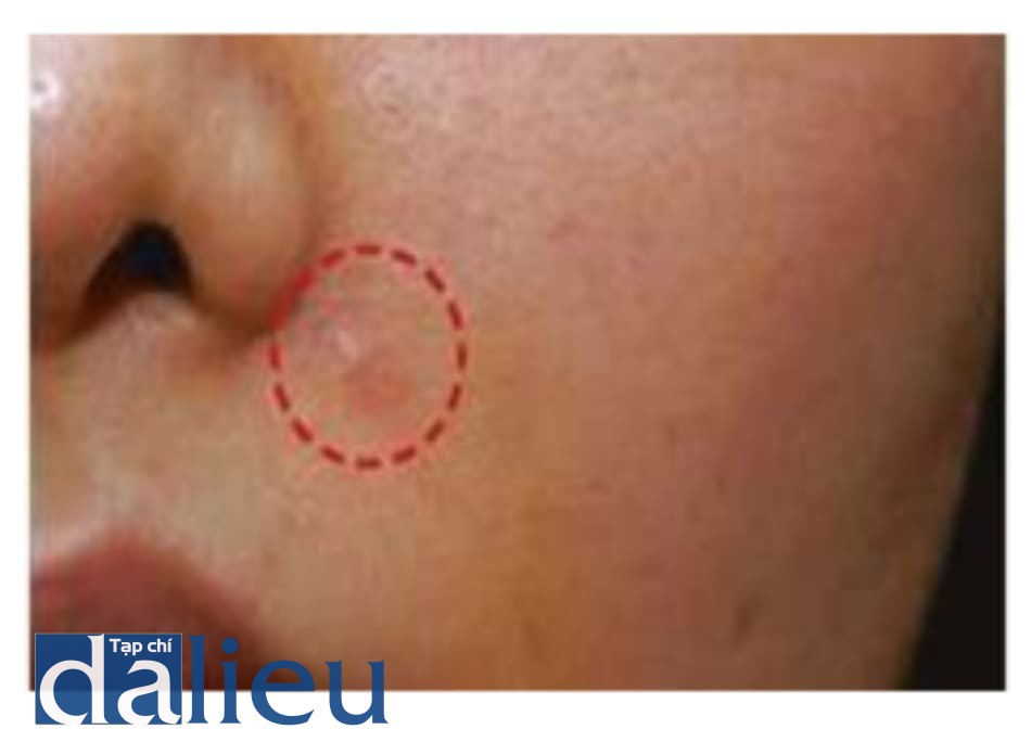 Hình 1.30 Dấu trên da. Dấu vĩnh viễn xuất hiện sau tiêm nông vào rãnh mũi má.