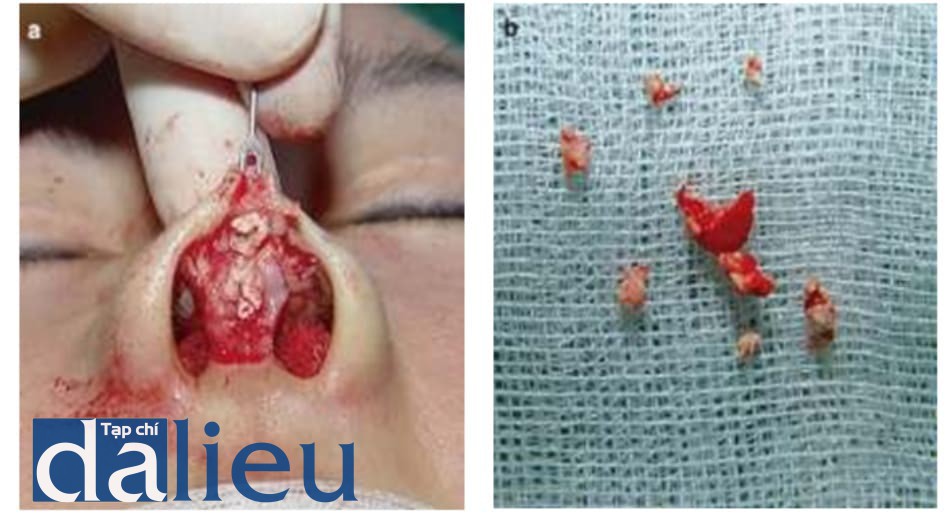 Hình 1.7 Loại bỏ filler canxi hydroxyapatite (sau 2 tuần). Hình ảnh phẫu thuật: canxi hydroxyapatite trong phẫu thuật mũi hở. (a) Các phần tử đông tụ lại cùng mô kế cận trong 6 tháng sau tiêm. (b) Các phần tử canxi hydroxyapatite đã loại bỏ.
