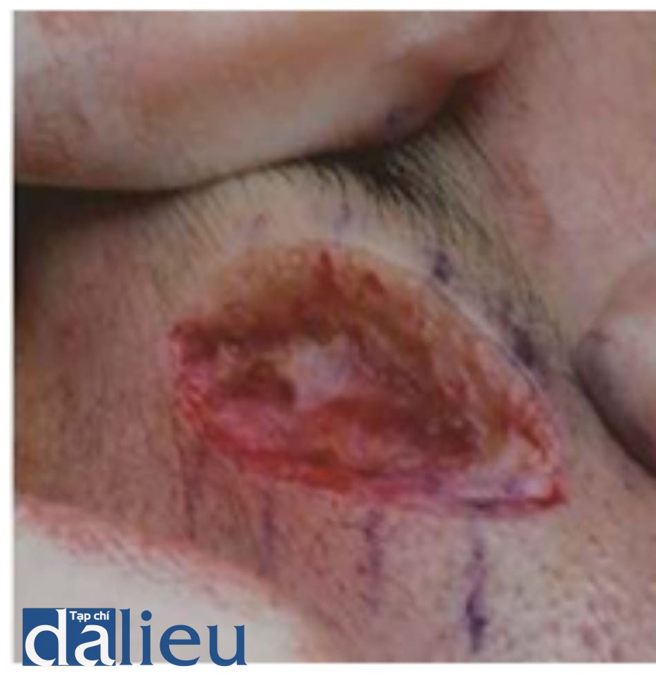 Hình 4.2 độ dày da tương đối của vùng diện trên gốc mũi. Độ dày da vùng diện trên gốc mũi quan sát thấy khi phẫu thuật cắt bỏ sẹo. Da vùng này dày hơn da khu vực trán.