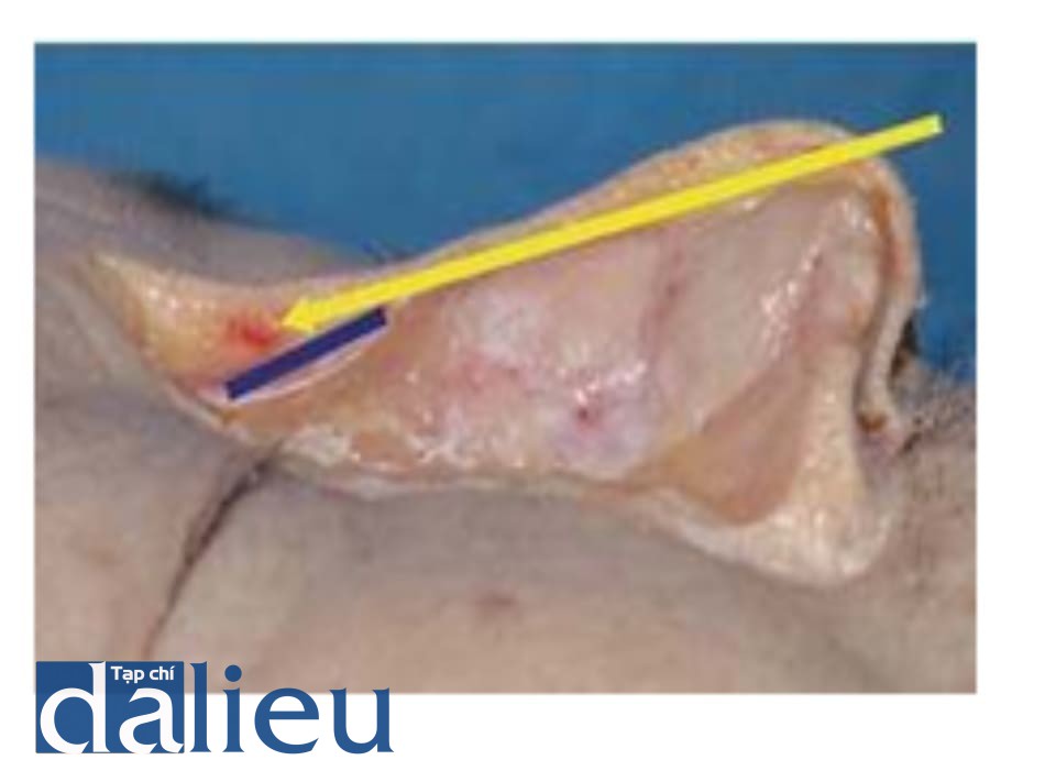 Hình 6.16 Kĩ thuật nguy hiểm khi dùng vi cannula dài trong nâng mũi. Khi dùng kim hay cannula dài, nên cân nhắc góc của xương mũi (đường xanh). Khi đầu kim đi qua phần sụn của xương, đầu kim có thể nằm trong lớp dưới da.