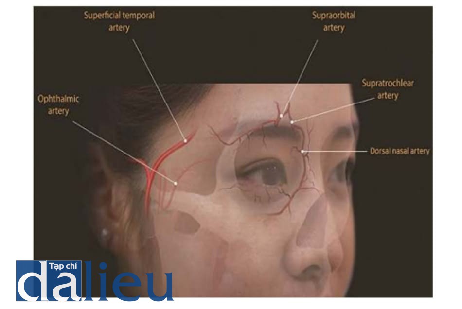 Hình 6.3 Các thông nối của ĐM mắt. Các phân nhánh ĐM mắt từ ĐM cảnh trong đi tới ĐM trên ròng rọc, ĐM trên ổ mắt và ĐM sống mũi