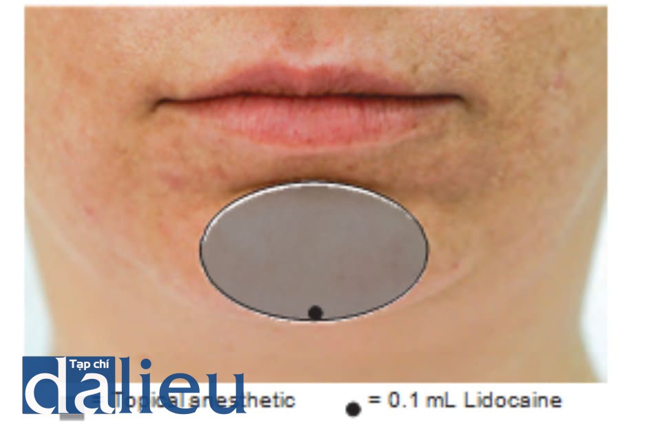 FIGURE 3 ● Anesthesia for chin augmentation dermal filler treatment.