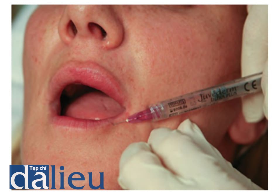 FIGURE 7 ● Mũi tiêm thứ hai cho điều trị làm đầy da da của viền môi dưới.