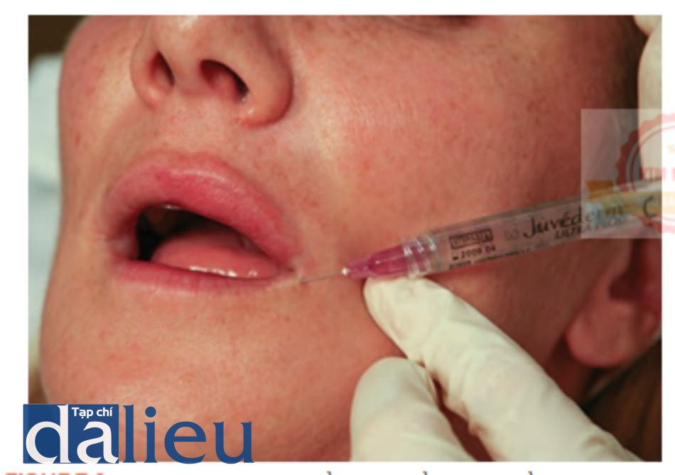 FIGURE 8 ● Mũi tiêm thứ ba cho điều trị làm đầy da của viền môi dưới.