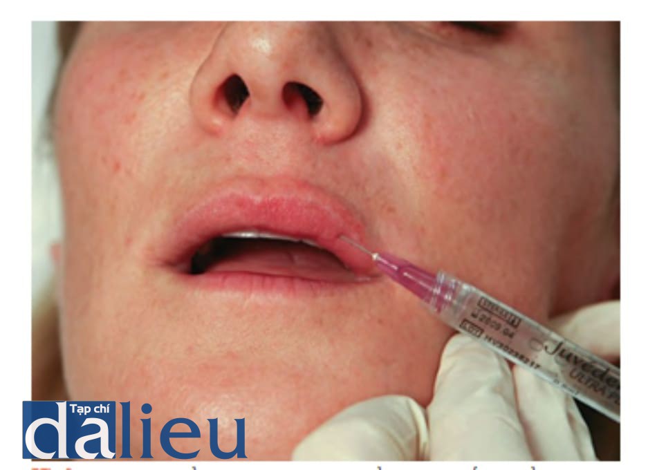 Hình 3 ● Mũi tiêm đầu tiên trong quá trình điều trị đưa chất làm đầy vào môi trên.
