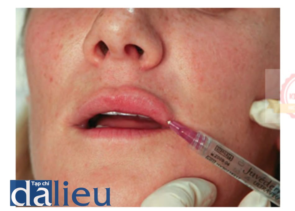 Hình 4 ● Mũi tiêm thứ hai trong quá trình điều trị đưa chất làm đầy vào môi trên.