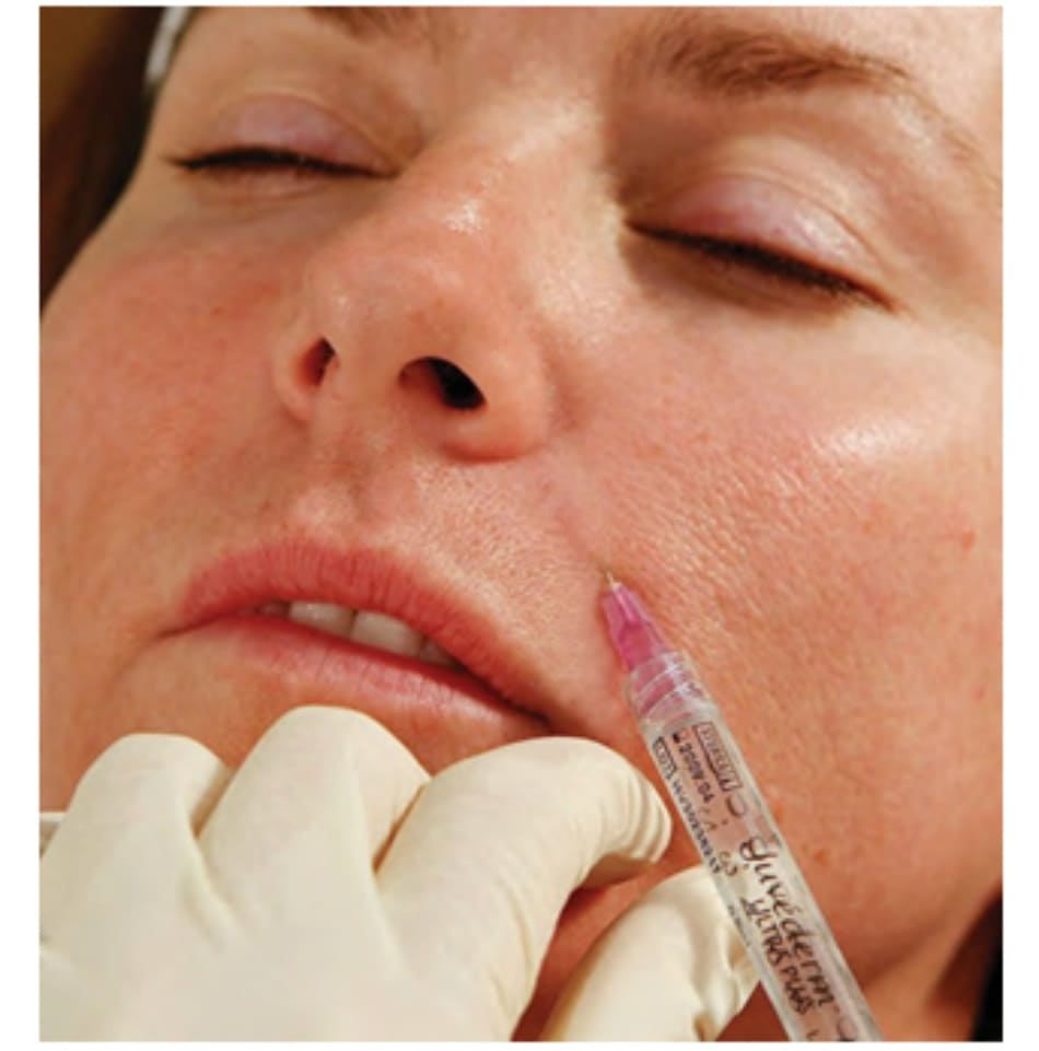 FIGURE 5 ● Mũi tiêm thứ hai cho điều trị làm đầy da mặt nếp gấp mũi - má.