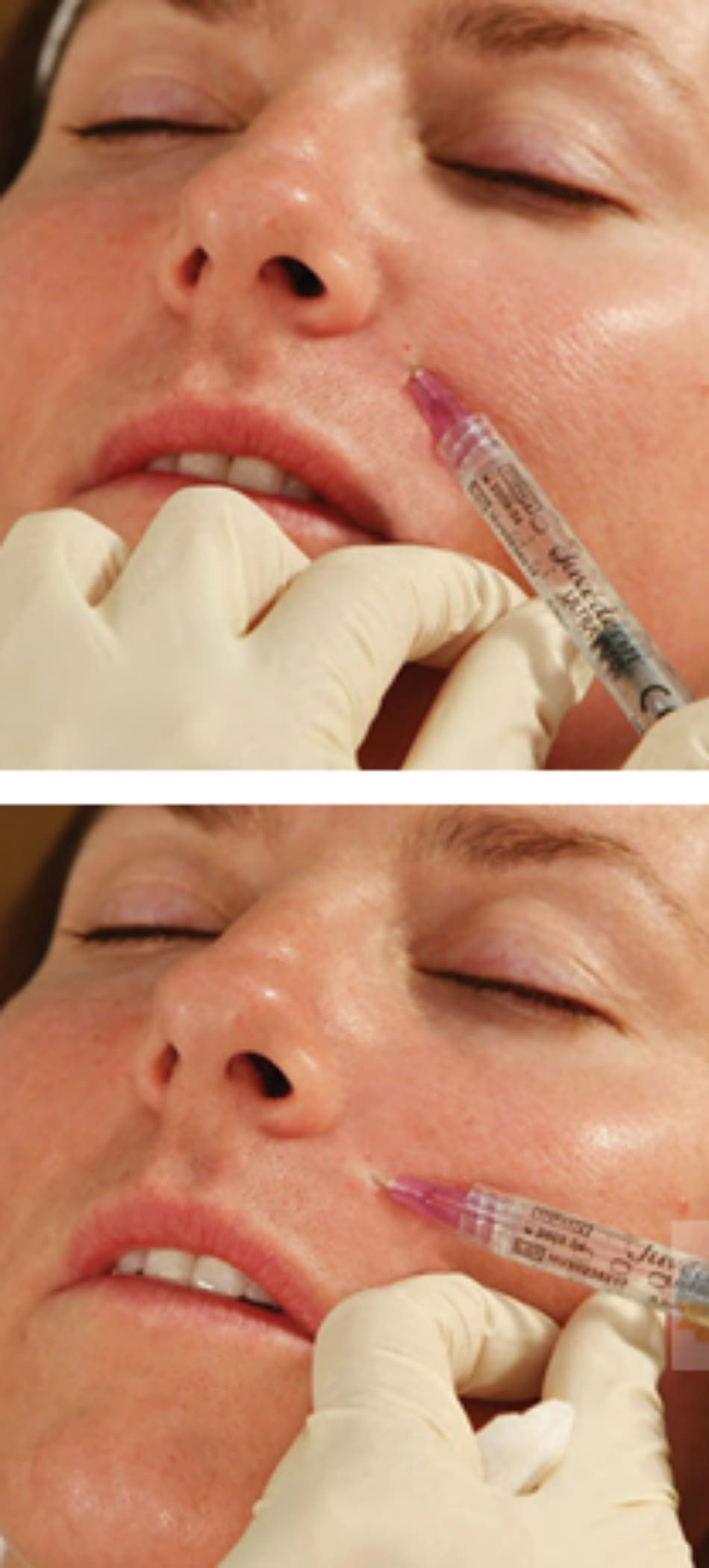 FIGURE 6 ● Điểm tiêm thứ ba cho điều trị làm đầy da nếp gấp mũi - má (A) với kỹ thuật hình quạt ở giữa (B).