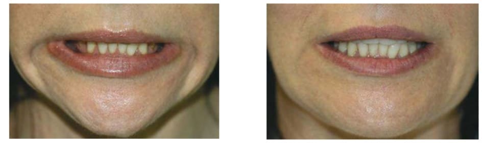 Hình 1. Nếp nhăn Marionette trước (A) và 2 tuần (B) sau điều trị botulinum toxin cơ hạ góc miệng, ảnh chụp khi cơ ở trạng thái co.