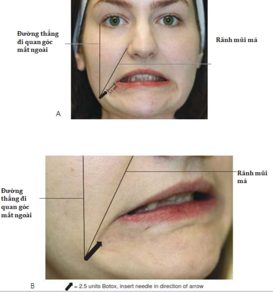 Hình 4: Tổng quan điểm tiêm và liều botulinum toxin trong điều trị nếp nhăn marionette. Nhìn từ phía trước (A) và nhìn nghiêng (B).