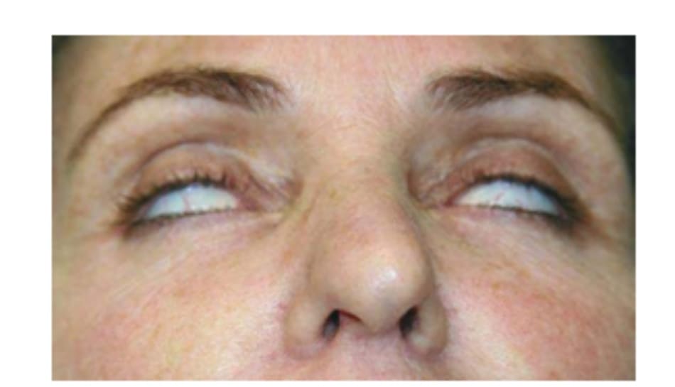 Hình 7 Hở mí, gặp ở bệnh nhân có tiền sử phẫu thuật mí mắt, là một chống chỉ định của điều trị botulinum toxin cho vùng mi mắt dưới