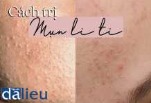 Cách trị mụn li ti