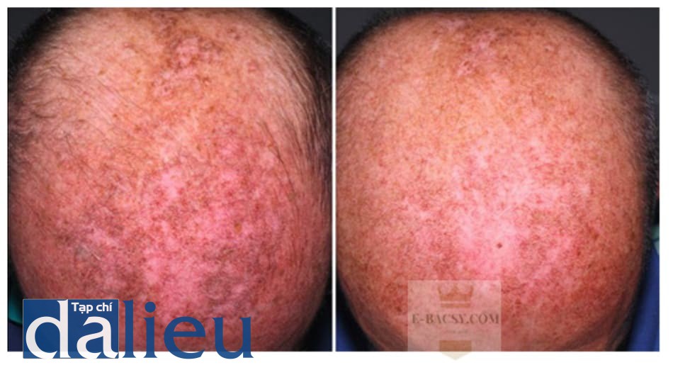 Hình 17: Điều trị dày sừng ánh sáng nặng trên da đầy bằng 3 lần phối hợp peel pyruvic 50% sau khi peel TCA 35%.