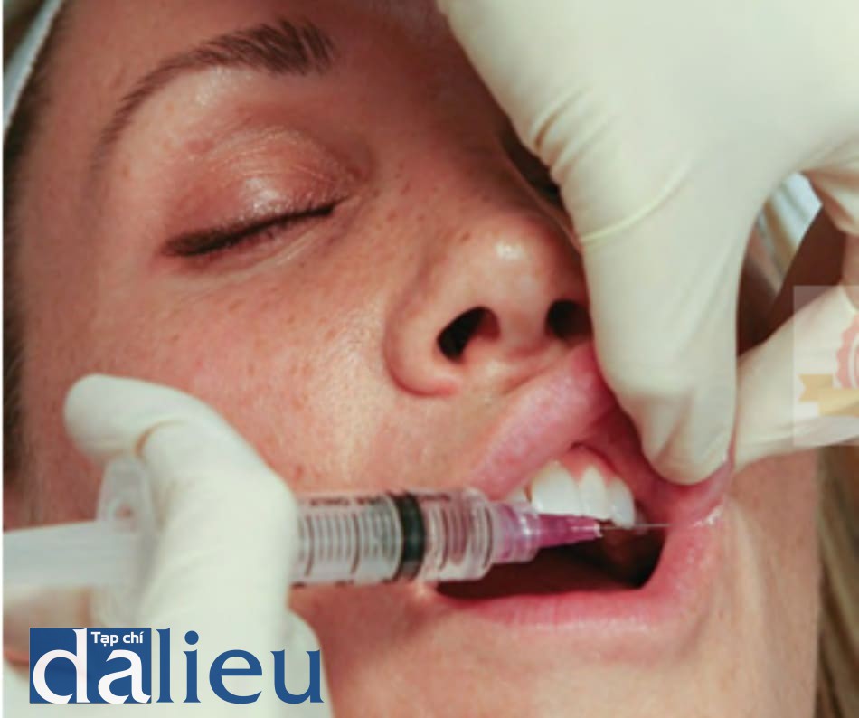 FIGURE 11 ● Kỹ thuật tiêm lidocaine ở mép môi.