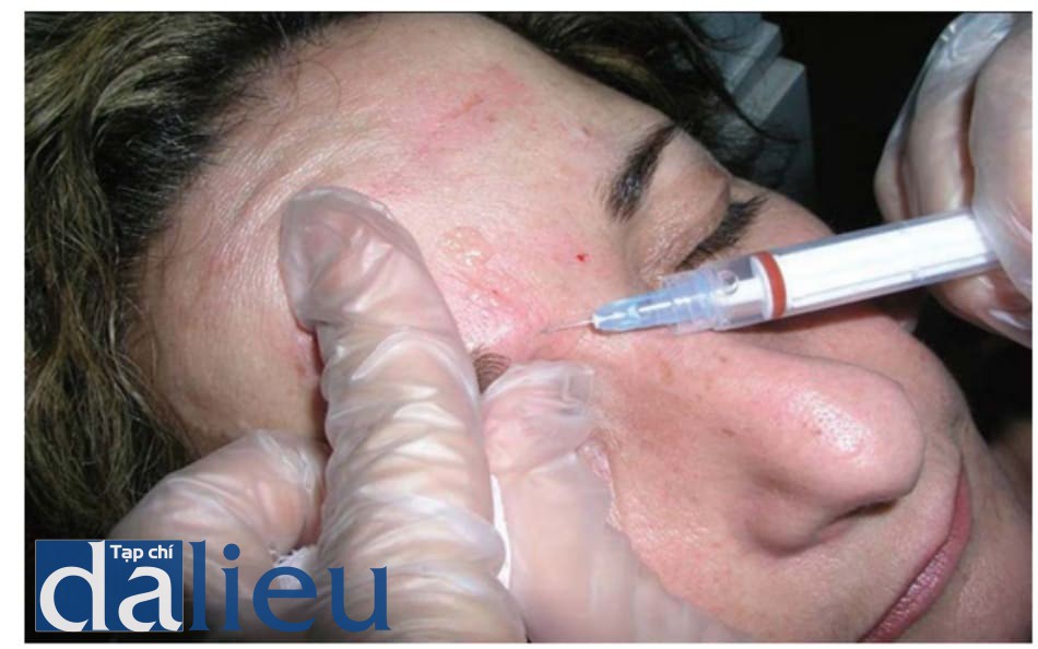 Hình 6.6 (a, b) Tiêm theo kĩ thuật picotage ở phần trên của mũi, hữu ích trong việc chuẩn bị da cho thủ thuật tiêm botulinum toxin