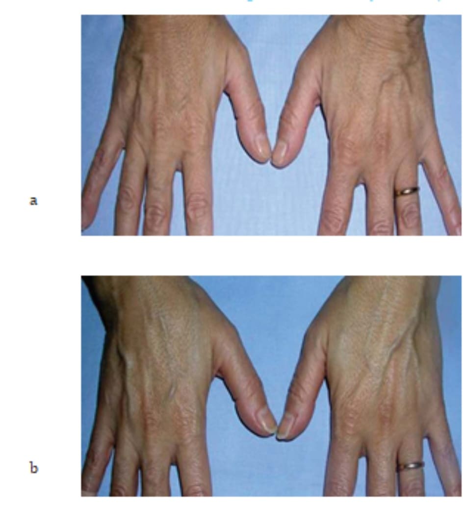 Hình 7.20 Bệnh nhân (a) trước và (b) 2 tuần sau điều trị