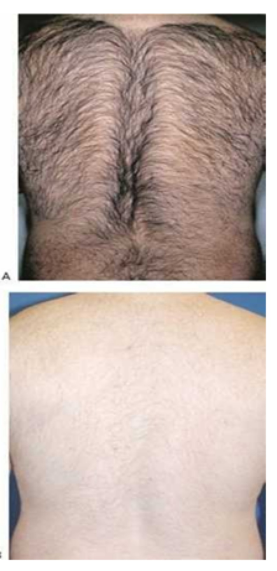Hình 13: Lông ở sau lưng trước khi (A) và sau khi (B) 6 lần điều trị triệt lông sử dụng xung ánh sáng tăng cường