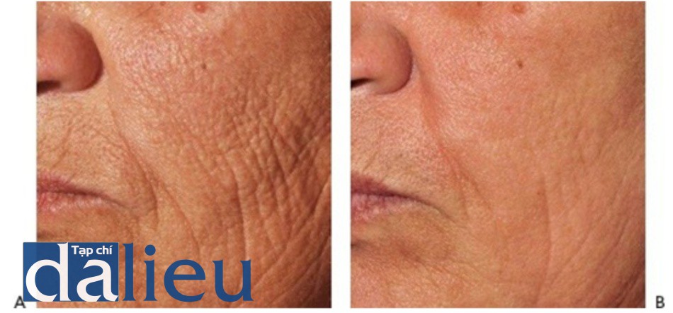 HÌNH 16 Tái tạo bề mặt da với laser phân đoạn xâm lấn điều trị cho nếp nhăn vùng má trước khi (A) và sau khi (B) một lần điều trị sử dụng YSGG laser. (với sự cho phép của BS B. DiBernardo và Cutera.)