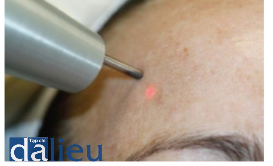 Hình 3: Kỹ thuật điều trị tái tạo bề mặt da không xâm lấn sử dụng đầu Q-switched 1064 nm laser