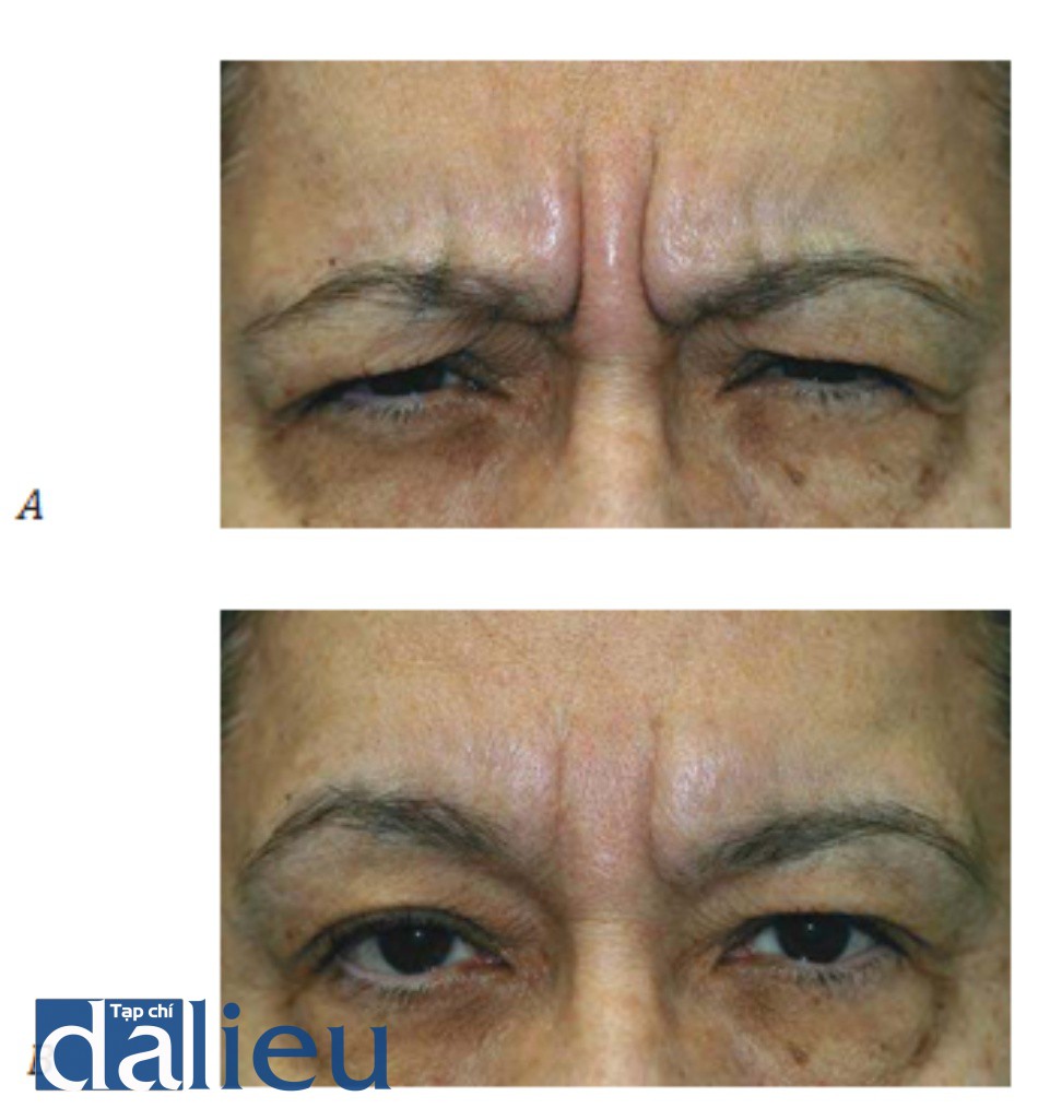 Hình 2. Nếp nhăn động do phức hợp cơ giữa 2 cung mày co ở một bệnh nhân lớn tuổi (A) và hình ảnh nếp nhăn tĩnh khi nhóm cơ này ở trạng thái nghỉ (B).