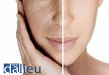 Laser điều trị tổn thương mạch máu: nguyên lý, chỉ định, ưu nhược điểm