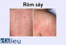 Hình ảnh Rôm sảy