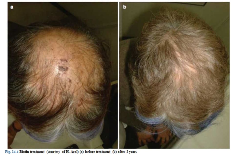 Fig. 14.4 Biotin treatment (courtesy of H. Aral) (a) before treatment (b) after 2 years