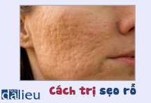 Cách trị sẹo rỗ