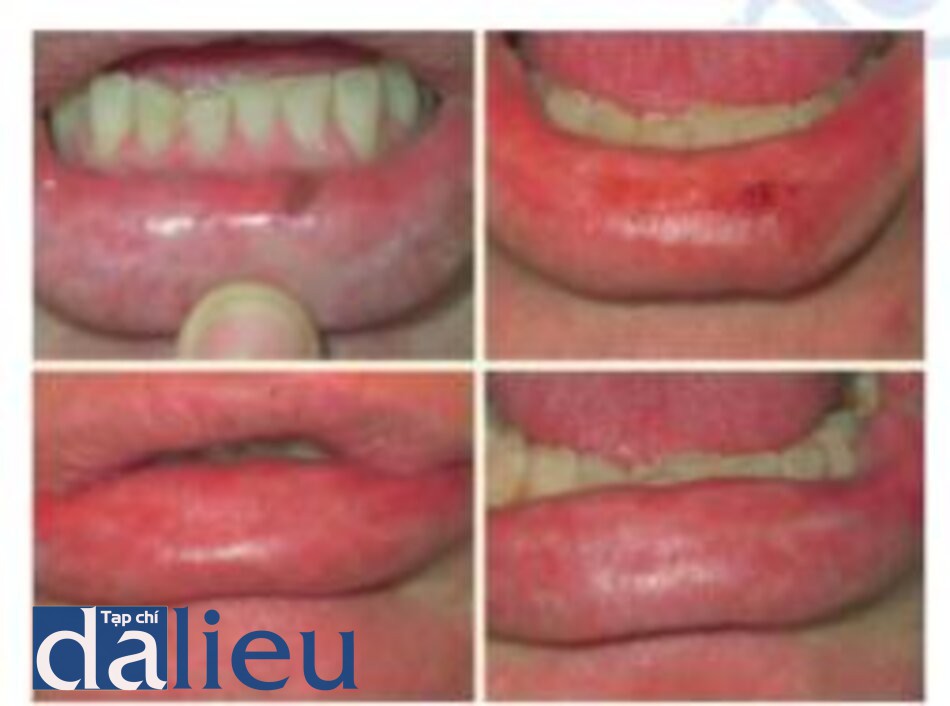 Fig. 1.10. a Before and b 3 months after full facial er-bium laser resurfacing and fat transfer