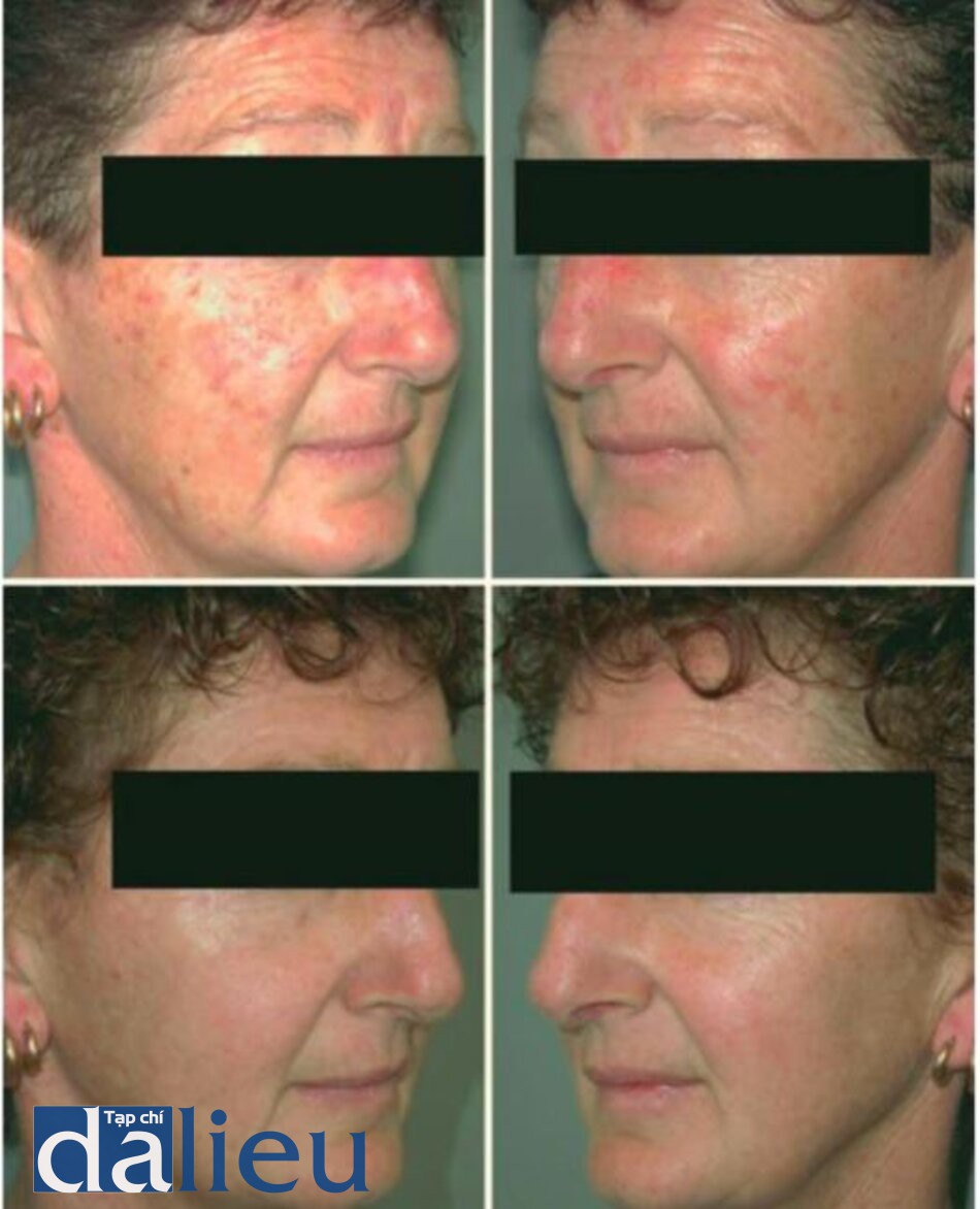 Fig. 1.21. “Photodynamic pho tore) u venation” utili of aminolevulinic acid. Before (top) and 3 months after zing a 532 nm laser after a 30 min prior application (bottom) three treatment sessions