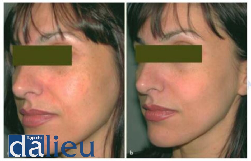 Fig. 1.25 a, b. Patient, with dyschromia a before and b after three treatments with a KTPiYAG laser