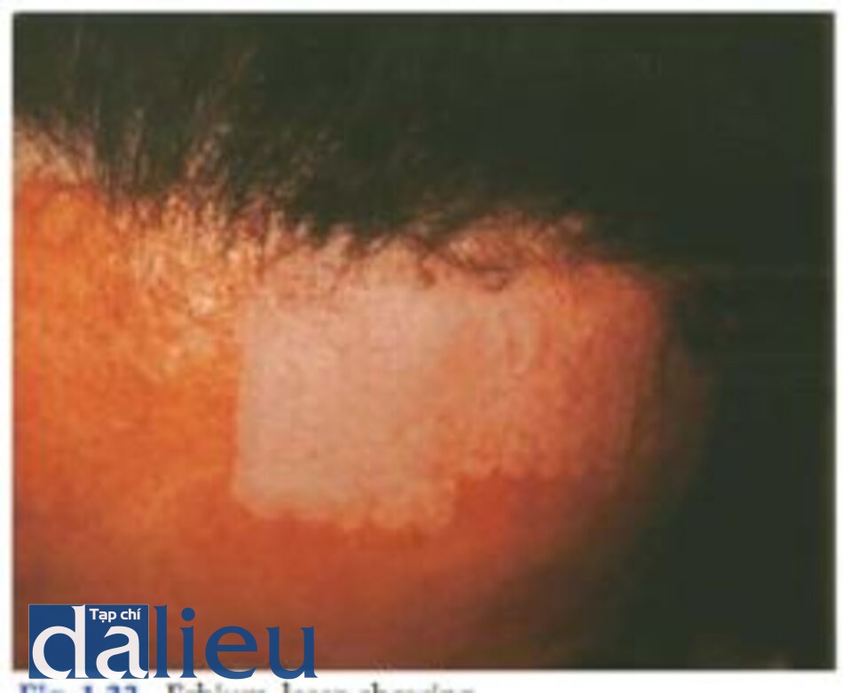 Fig. 1.32. Fractionated resurfacing, as well as fat transfer for postacne scarring, upper Before treatment, lower after treatment. Image courtesy of Reliant Technologies