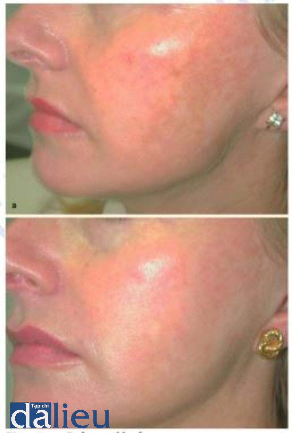 Fig. 1.34. a Before and b after visible light lasers for facial dyschromia