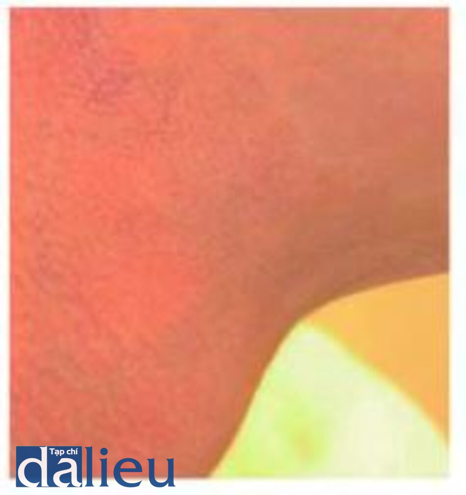 Fig. 1.41. Relative hypopigmentation due to removal of facial sun-damaged skin