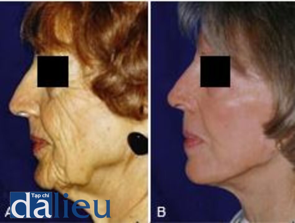 Fig.. 7.19 A, Một phụ nữ 75 tuổi bị lão hóa đáng kể về cấu trúc và kết cấu da. B, Kết quả ở tuổi 81, 5 năm sau khi căng da mặt và 1 năm sau khi peel mặt, thể hiện giá trị của việc kết hợp đúng các khía cạnh
