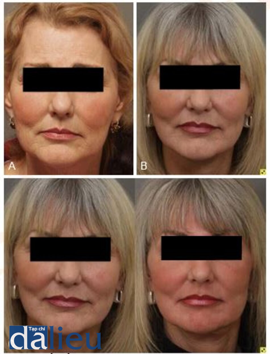 Fig.. 7.20 A, Một phụ nữ 63 tuổi thể hiện cả ba khía cạnh của quá trình lão hóa da mặt: lỏng lẻo điển hình, nhăn nhó và nhăn nheo. B, Một năm sau khi nâng cấp và chuyển giao chất béo với những cải tiến đáng chú ý về cấu trúc và khối lượng. C, Một năm rưỡi sau peel. Sự cải thiện của kết cấu và nếp nhăn là thành phần cuối cùng kết nối mọi thứ với nhau để tạo ra một kết quả toàn diện.