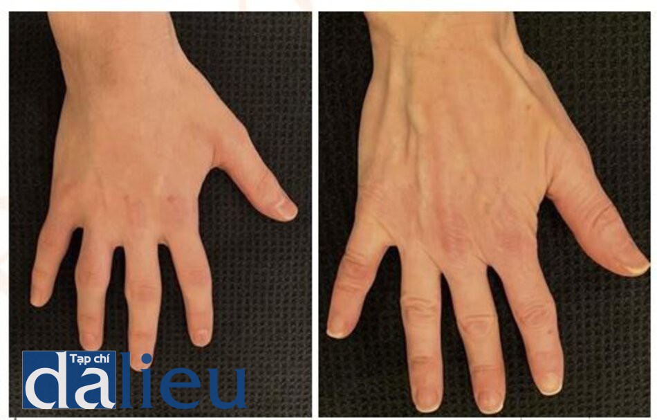 Fig. 6.2 So sánh tay “trẻ” bên trái với tay “trưởng thành” bên phải. Các đường tĩnh mạch ,gân nổi rõ và da sần xùi là đặc điểm của bàn tay lão hóa.