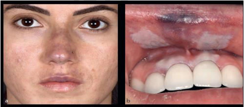 Hình 1 : Báo cáo ca thiếu máu sau filler : (a) Nhìn trước của bệnh nhân sau 12h tiêm làm đầy. chú ý màu đỏ xanh trên da mũi và môi trên. (b) Nhìn trong miệng thấy tiêm filler ở gốc mũi ảnh hưởng đến cung cấp máu ở môi trên và lợi sau môi trên.
