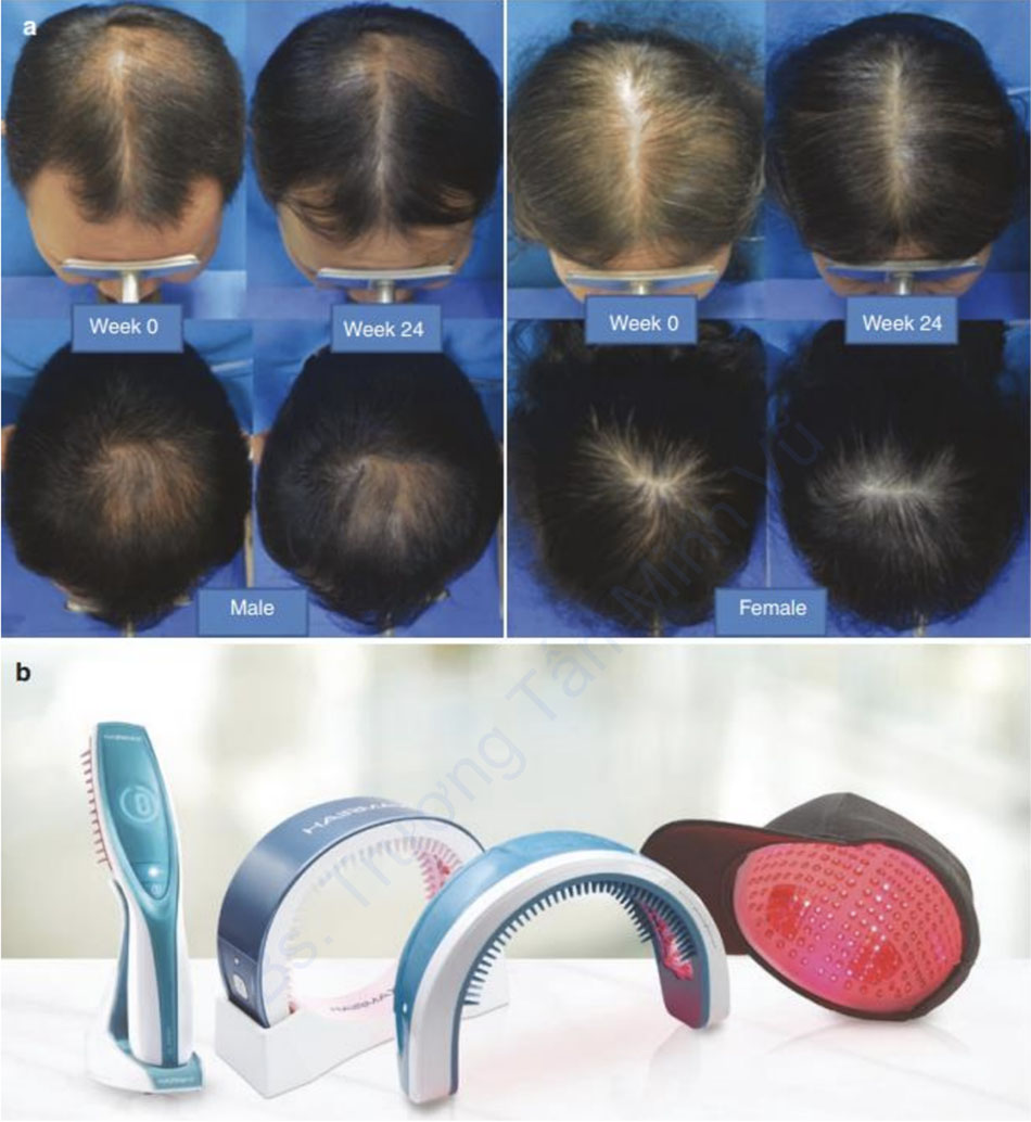 Hình 8.3 (a) Sự cải thiện mức độ trung bình sự phát triển của tóc ở những bệnh nhân được điều trị bằng mũ laser lúc ban đầu và sau 24 tuần [23]. (b) Các thiết bị ánh sáng thường được sử dụng để chữa rụng tóc