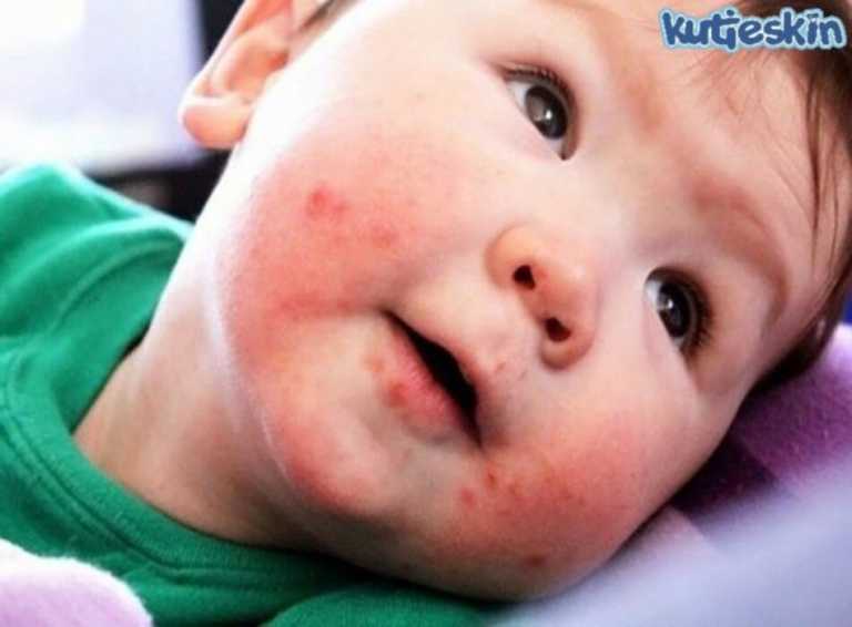 Phân loại và biểu hiện viêm da tiếp xúc ở trẻ em