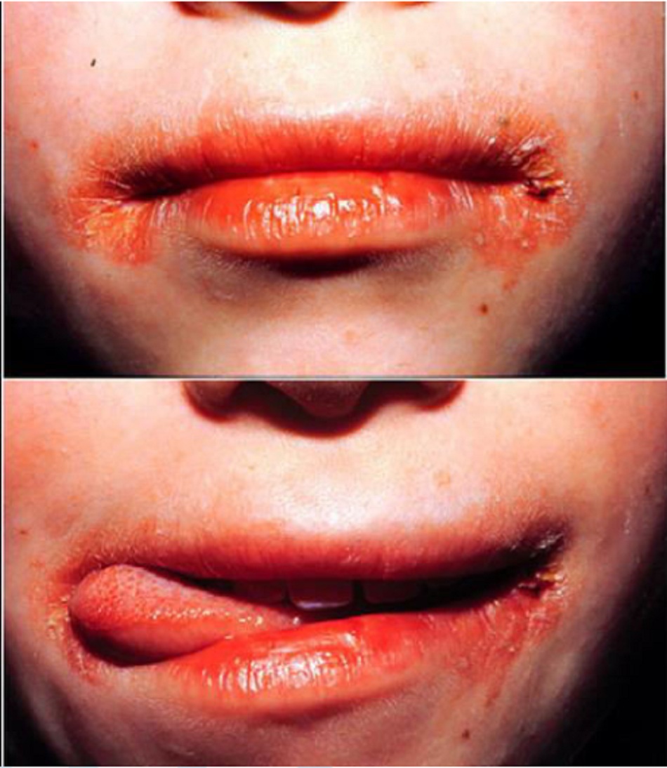 Hình 2 : Lip-licker’s dermatitis