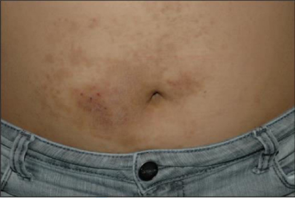 Hình 4 : ACD do niken. Sự phân bố quanh rốn này là một dạng điển hình tình trạng được gọi là "bệnh viêm da do nút quần jean."
